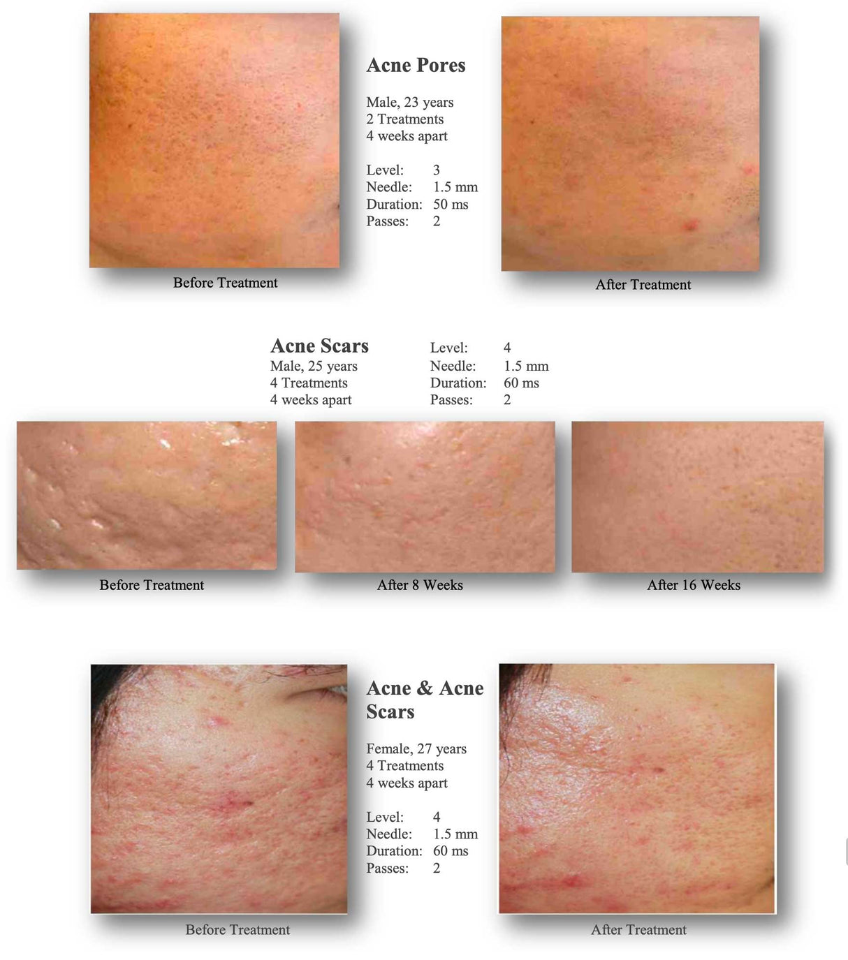 Silhouet-Tone RF Microneedling Body Shape | Advanced RF Skin Rejuvenation