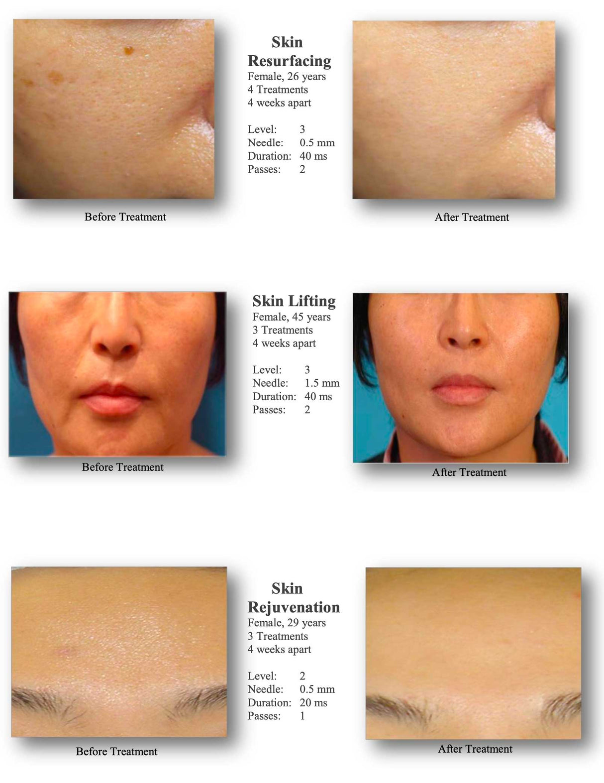 Silhouet-Tone RF Microneedling Body Shape | Advanced RF Skin Rejuvenation