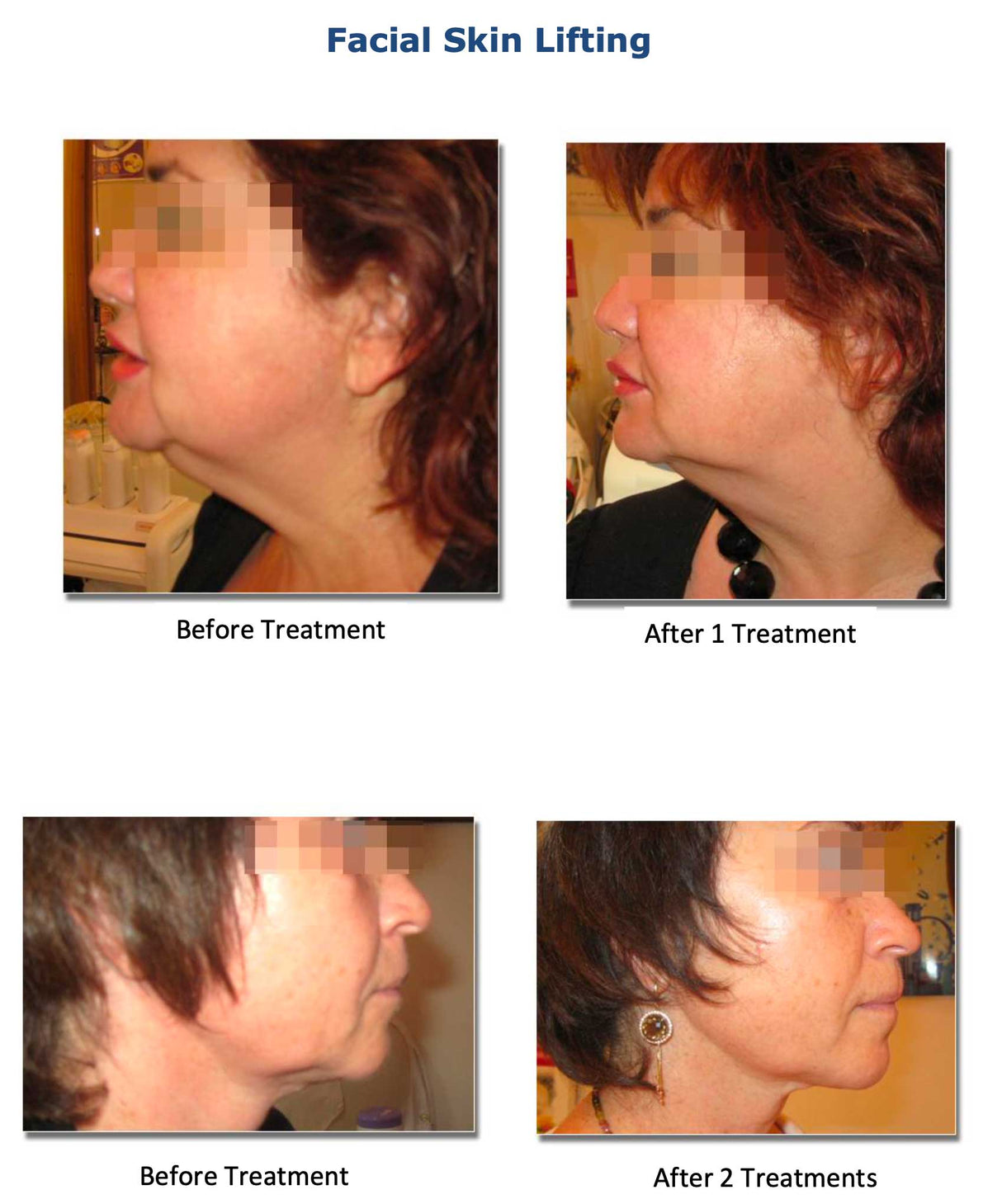 Silhouet-Tone RF Microneedling Body Shape | Advanced RF Skin Rejuvenation