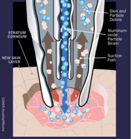 Silhouet-Tone Essential Peel Microdermabrasion Unit | Luxury Crystal Turbo-Flow System