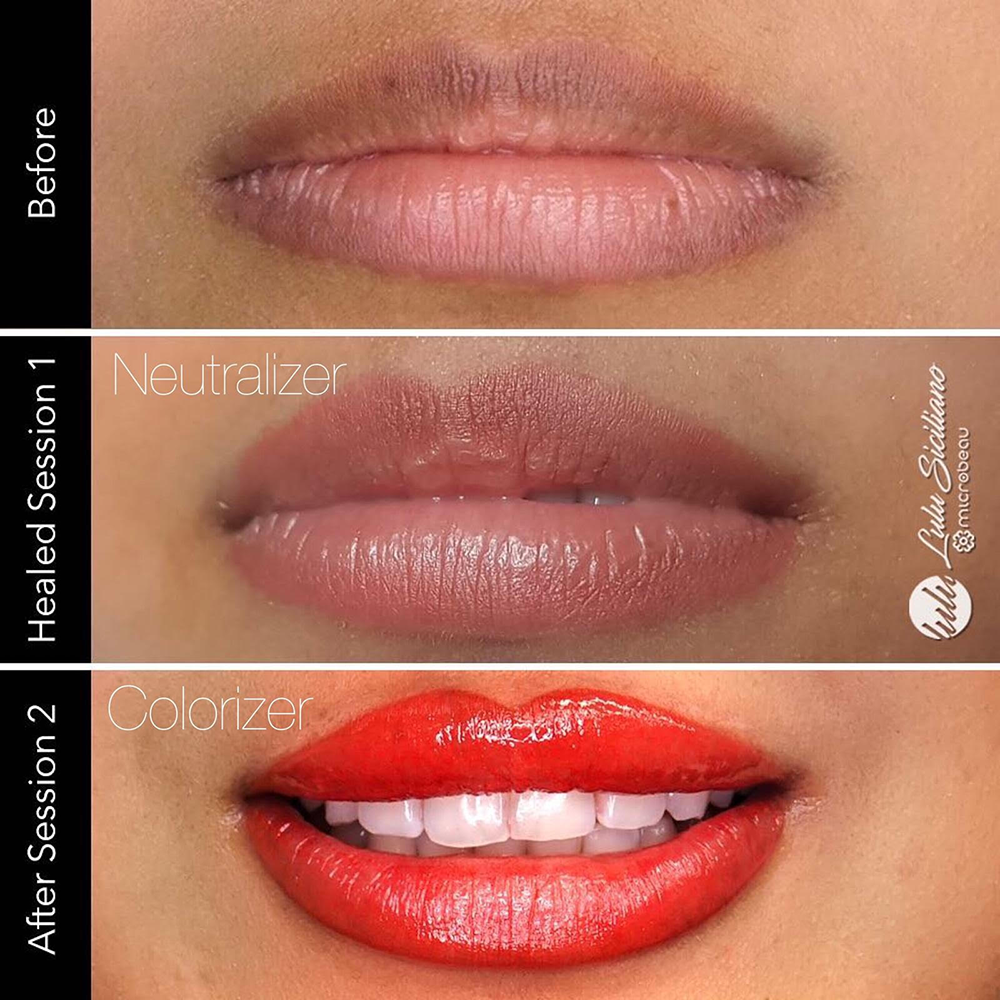Lip neutralization before treatment, healed after Neutralizer, and after a second session with Colorizer