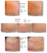 Silhouet-Tone RF Microneedling Body Shape | Advanced RF Skin Rejuvenation