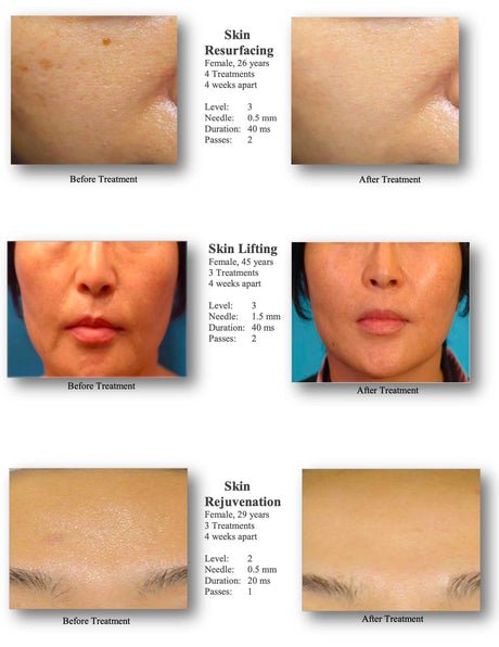 Silhouet-Tone RF Microneedling Body Shape | Advanced RF Skin Rejuvenation