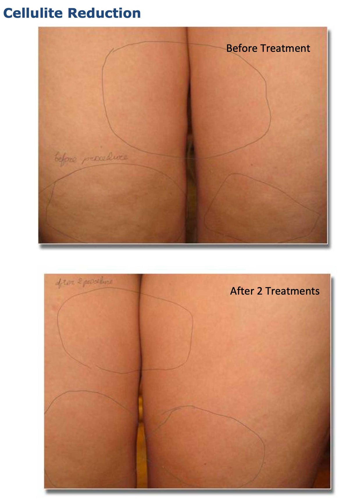 Silhouet-Tone RF Microneedling Body Shape | Advanced RF Skin Rejuvenation