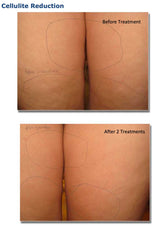 Silhouet-Tone RF Microneedling Body Shape | Advanced RF Skin Rejuvenation