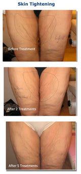 Silhouet-Tone RF Microneedling Body Shape | Advanced RF Skin Rejuvenation